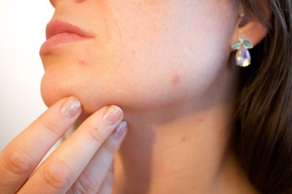acne punti neri